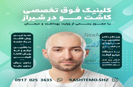 کاشت موی طبیعی در شیراز