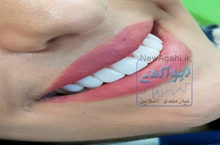 ایمپلنت و زیبایی ،( اقساط)