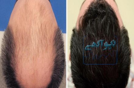 کاشت مو طبیعی با شرایط اقساطی