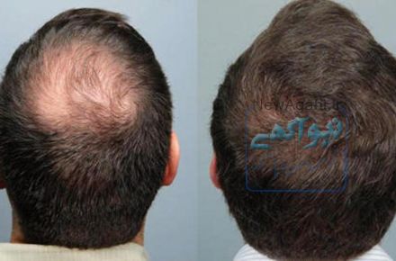 کاشت مو طبیعی با شرایط اقساطی