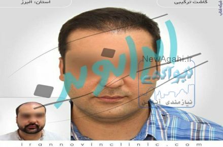 کاشت مو طبیعی با یک میلیون تومان