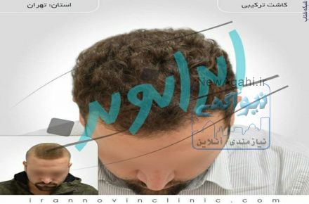کاشت مو طبیعی با یک میلیون تومان