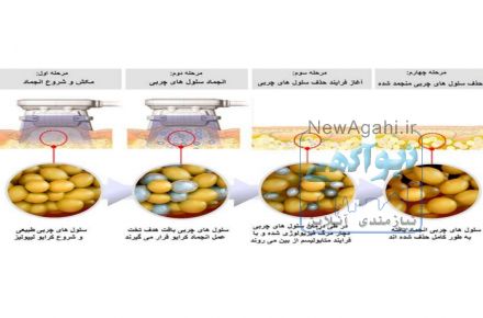 کرایولیپولیز ۲۰۲۱ بکو با ۴۵ درصد تخفیف دائمی پد آنتی فریز!