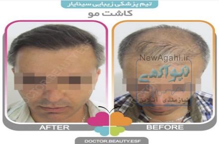 کاشت مو در اصفهان