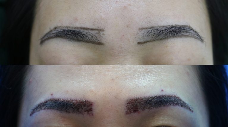 کاشت مو / ابرو / ریش نگین گرگان ( یک روزه / اقساطی)