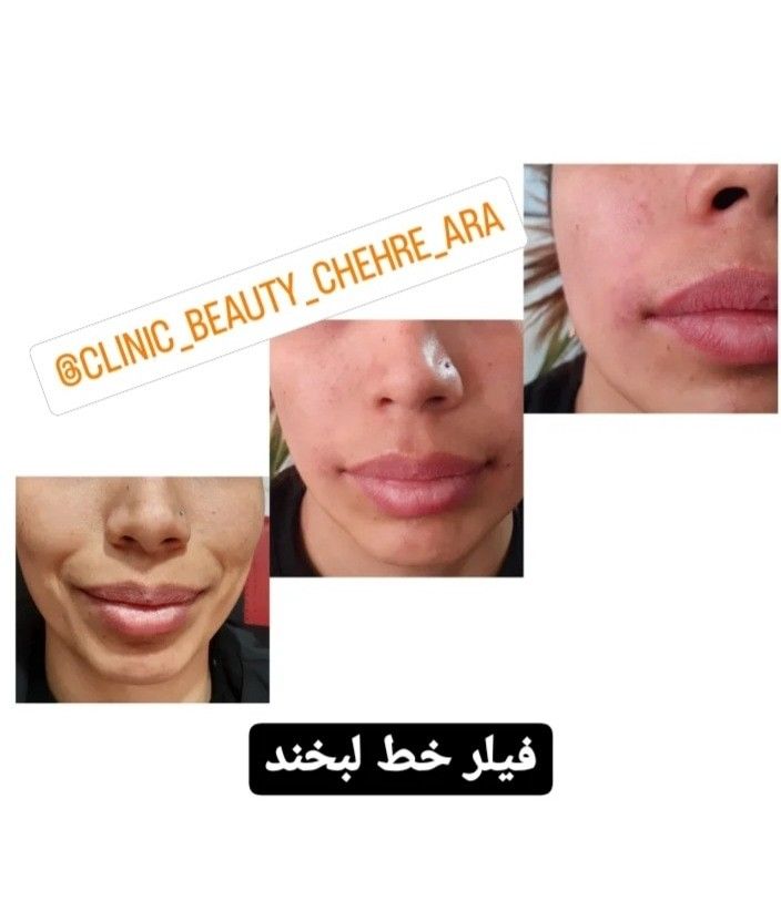 اموزش بوتاکس وژل