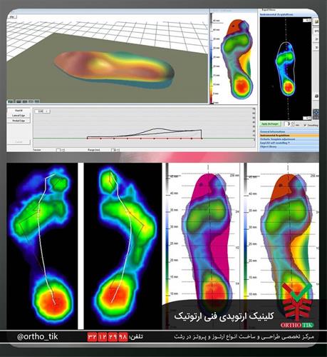 کفی طبی با اسکن 3 بعدی - گیلان