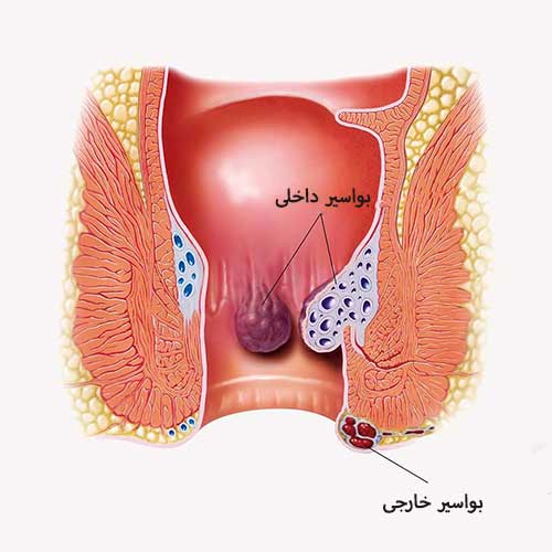 مرکز درمان هموروئید، شقاق، کیست مویی، فیستول و زگیل در تهران