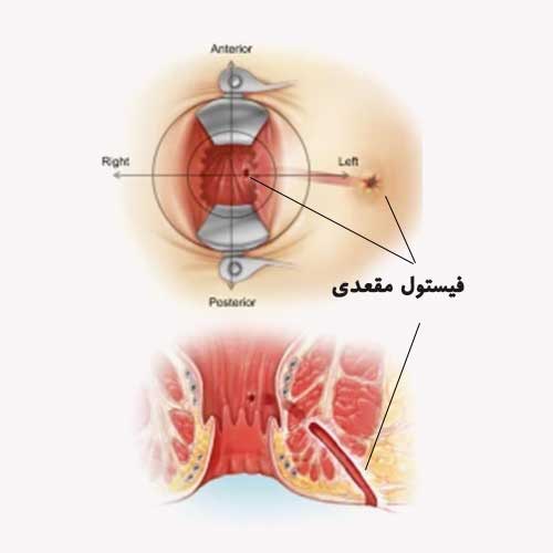 مرکز درمان هموروئید، شقاق، کیست مویی، فیستول و زگیل در تهران