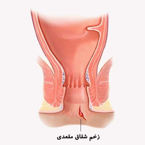 مرکز درمان هموروئید، شقاق، کیست مویی، فیستول و زگیل در تهران