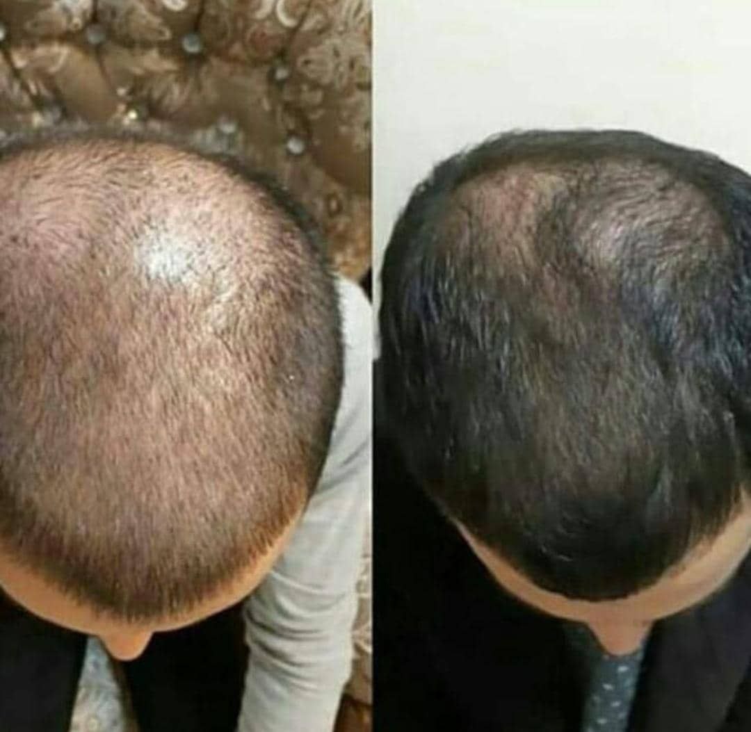 اسپری ضد ریزش و رویش مجدد مو