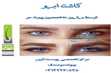کاشت ابرو