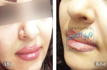 تزریق ژل لب
