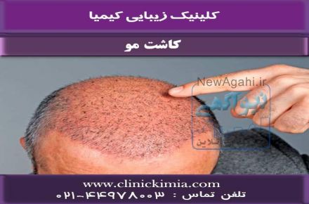 کاشت مو