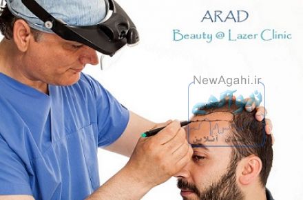 کاشت موی طبیعی