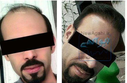 تخفیف کاشت مو کلینیک آی سیما
