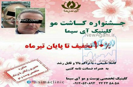 تخفیف کاشت مو کلینیک آی سیما