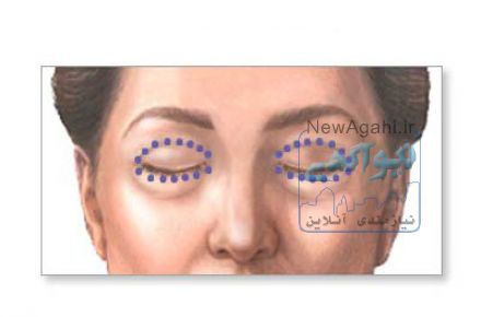 جراحی زیبایی پلک