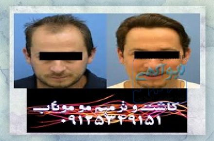 کاشت و ترمیم مو