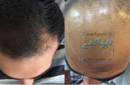 داروی رشد موی دکتر نوروزیان