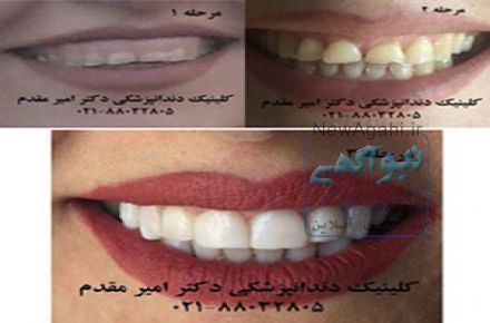 دندانپزشک ملاصدرا دکتر امیر مقدم  02188032805 لامینیت دندان،ایمپلنت دندان،اصلاح طرح لبخند،کاشت دندان