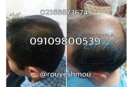 همه چیز درمورد دکتر نوروزیان وپکیج رویش مجدد مو