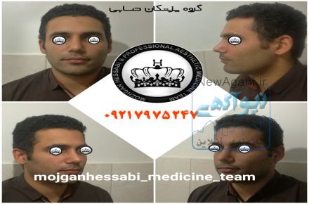 عمل زیبایی بینی