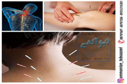 درمان آرتروز توسط طب سوزنی