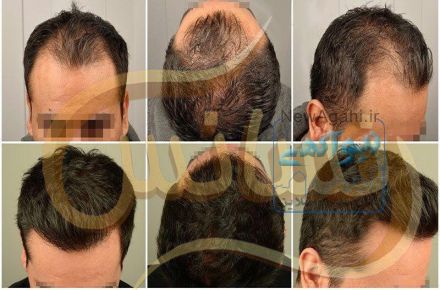 کلینیک کاشت مو رنسانس