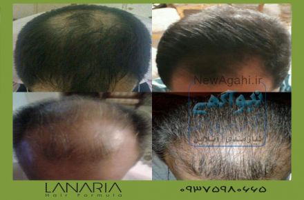 تونیک تقویت کننده و ضد ریزش مو لاناریا
