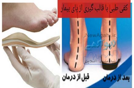 اصلاح صافی کف پا  