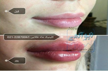 کلینیک تخصصی تزریق ژل و بوتاکس زیبایی پوست و مو ماه طلایی