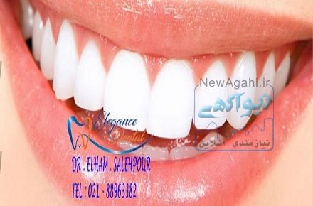 ترمیم لمینیت دندان | ترمیم ونیر کامپوزیت | ترمیم روکش دندان | ترمیم لمینیت سرامیکی