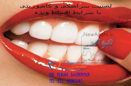 ماندگاری ونیر کامپوزیت چند ماه است | علت شکستن کامپوزیت دندان