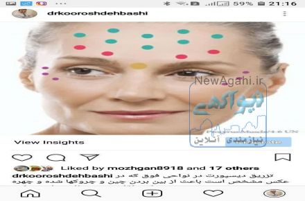 کرایولیپولیز