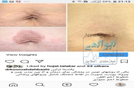 کرایولیپولیز
