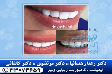 بهترین متخصص ایمپلنت در شرق تهران