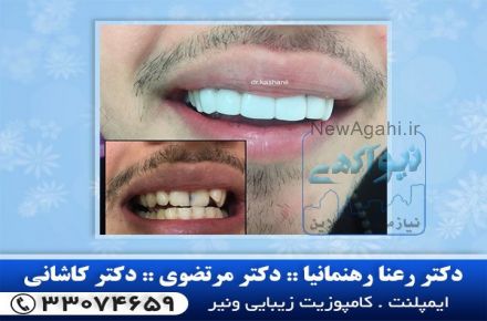 بهترین متخصص ایمپلنت در شرق تهران