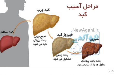 درمان قطعی کبد چرب ، بیماری خاموش!