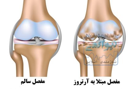 بهبودی کامل آرتروز! 