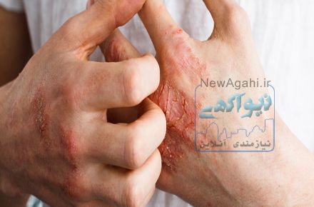 درمان قطعی و کامل پسوریازیس
