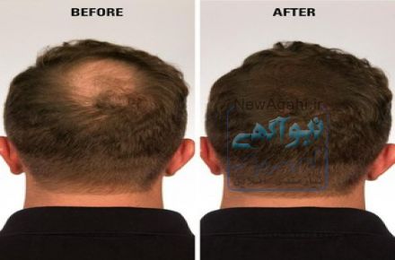 تاپیک پودر پرپشت کننده مو (کراتین اصل )