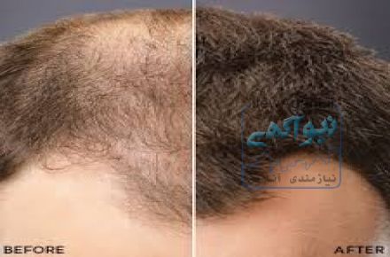 تاپیک پودر پرپشت کننده مو 100% کراتین اصل با جعبه و هولوگرام