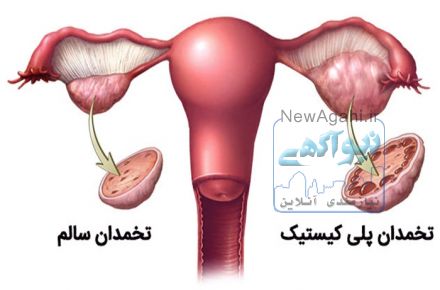 درمان کیست های تخمدانی با قارچ گانودرما