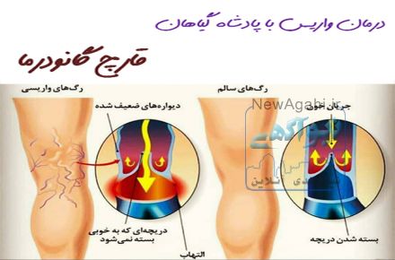 درمان خانگی واریس :)